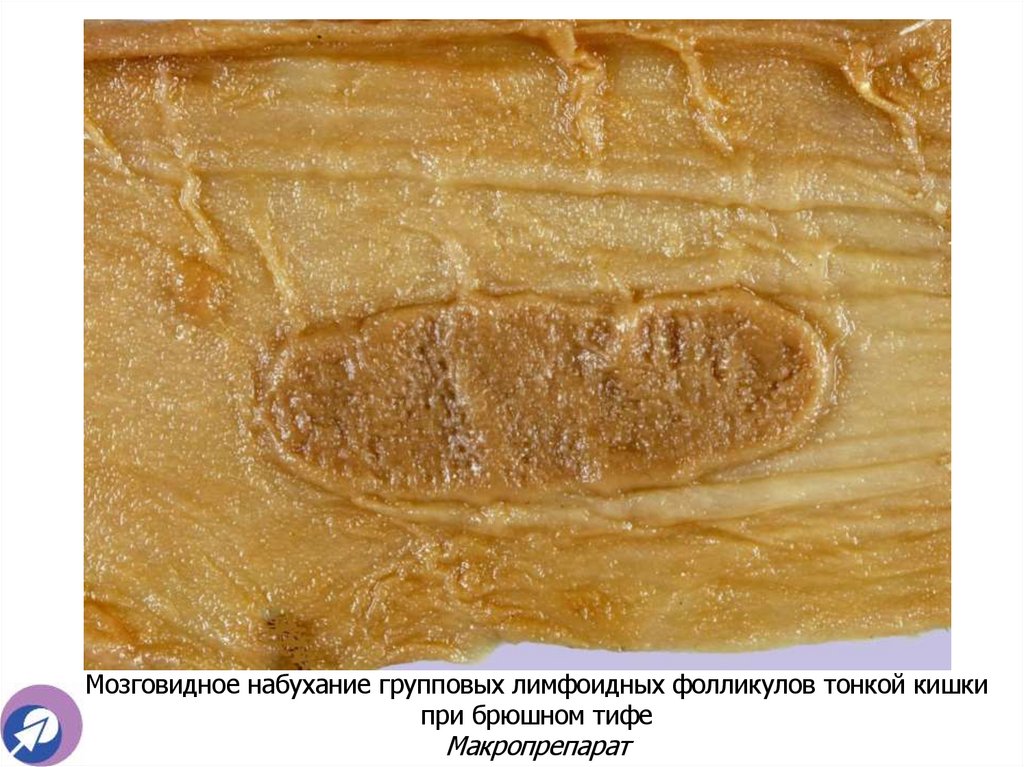 Мозговидное набухание групповых лимфоидных фолликулов тонкой кишки при брюшном тифе Макропрепарат