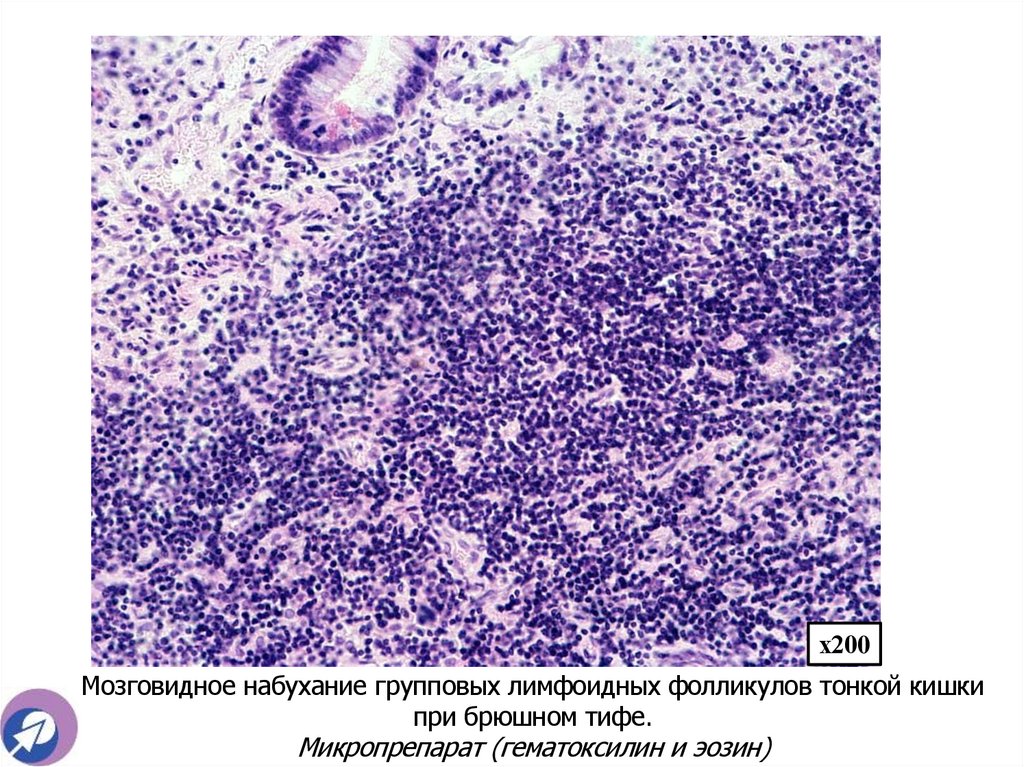 Мозговидное набухание групповых лимфоидных фолликулов тонкой кишки при брюшном тифе. Микропрепарат (гематоксилин и эозин)