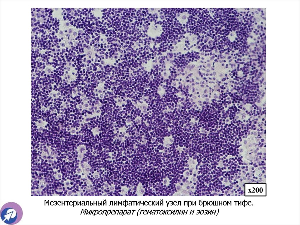 Мезентериальный лимфатический узел при брюшном тифе. Микропрепарат (гематоксилин и эозин)
