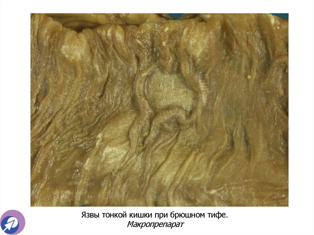Язвы тонкой кишки при брюшном тифе. Макропрепарат