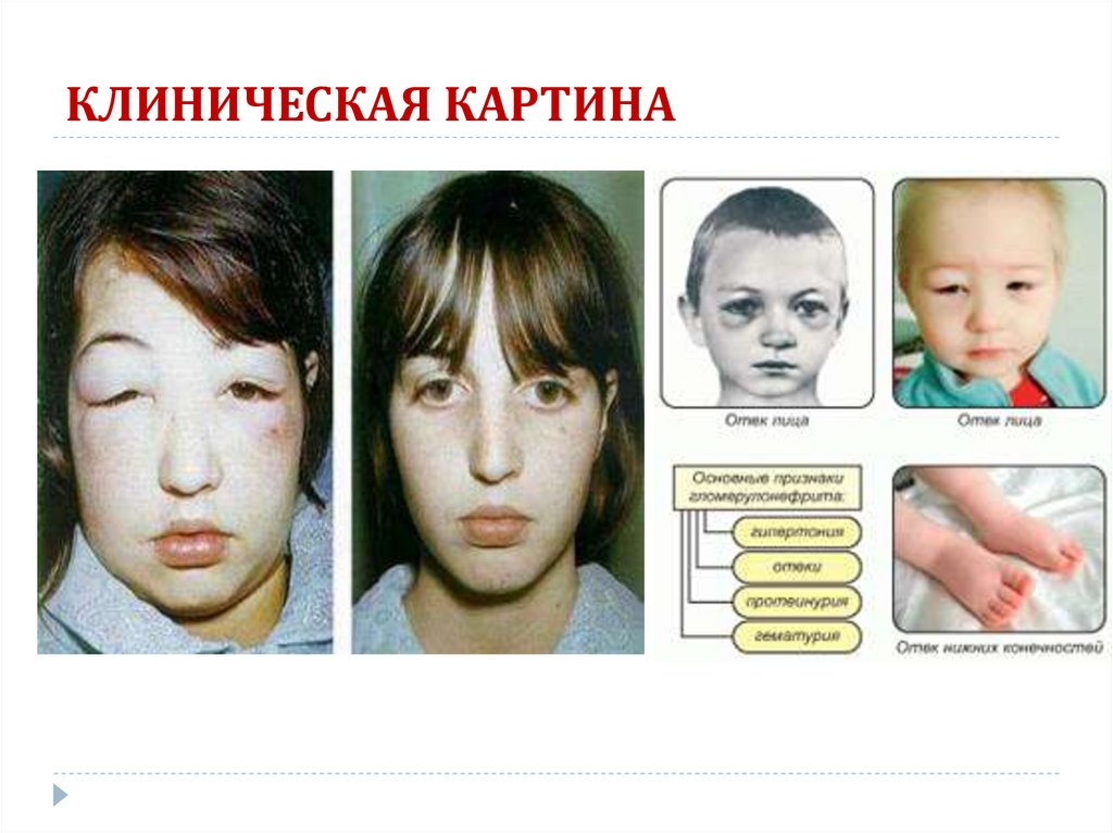 КЛИНИЧЕСКАЯ КАРТИНА