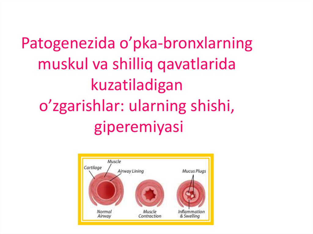 Patogenezida o’pka-bronxlarning muskul va shilliq qavatlarida kuzatiladigan o’zgarishlar: ularning shishi, giperemiyasi