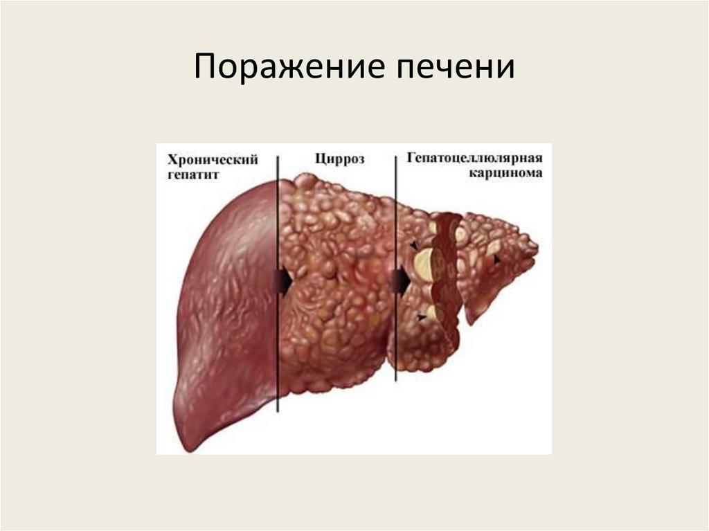 Поражение печени
