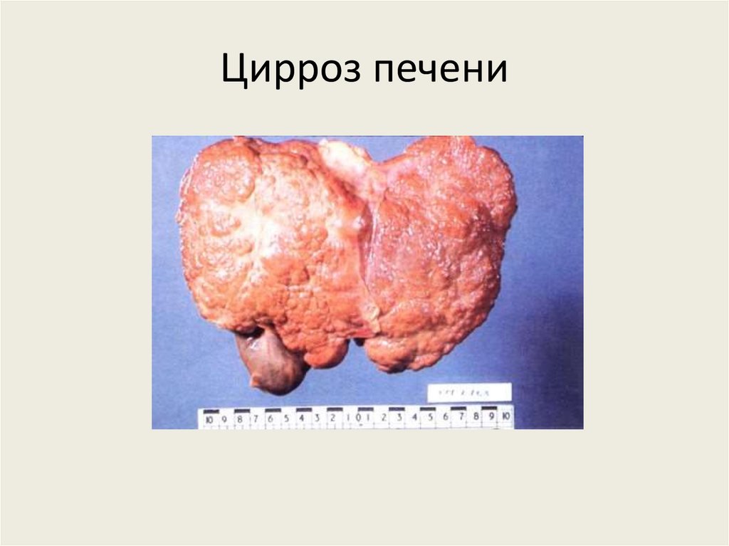 Цирроз печени