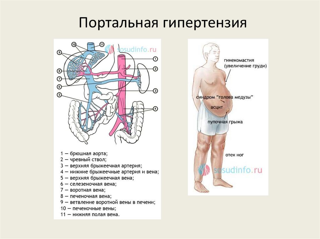 Портальная гипертензия