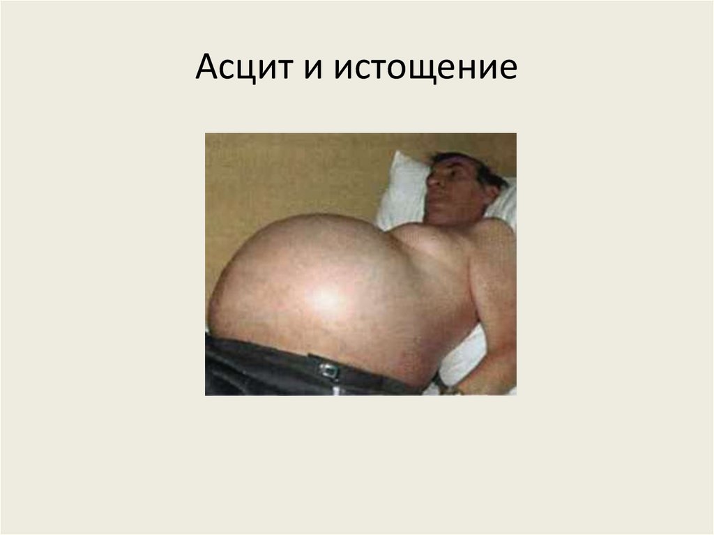 Асцит и истощение