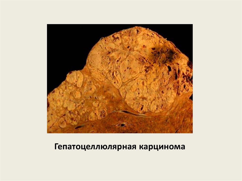 Гепатоцеллюлярная карцинома