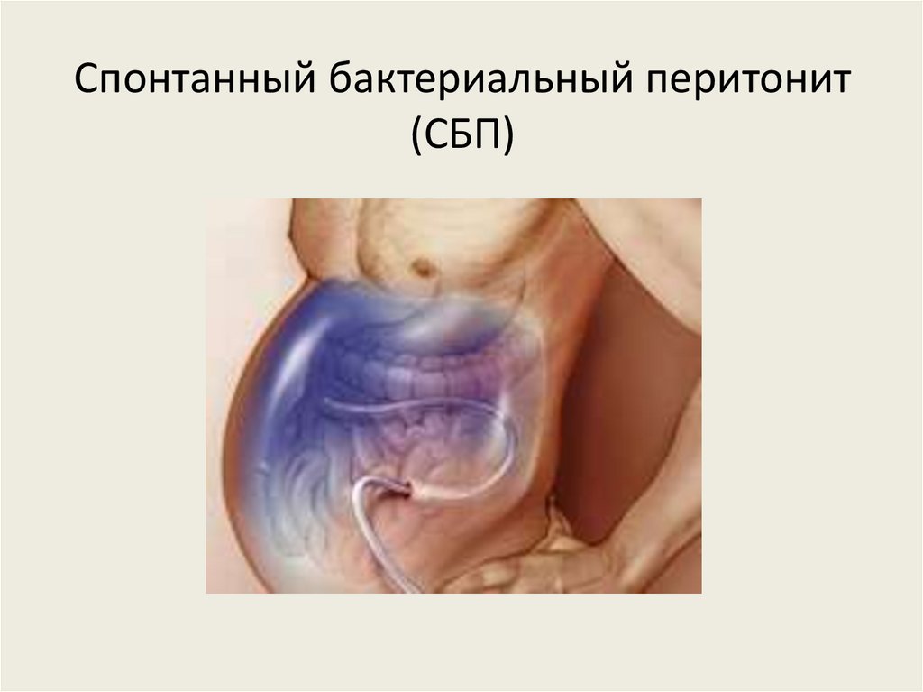 Спонтанный бактериальный перитонит (СБП)