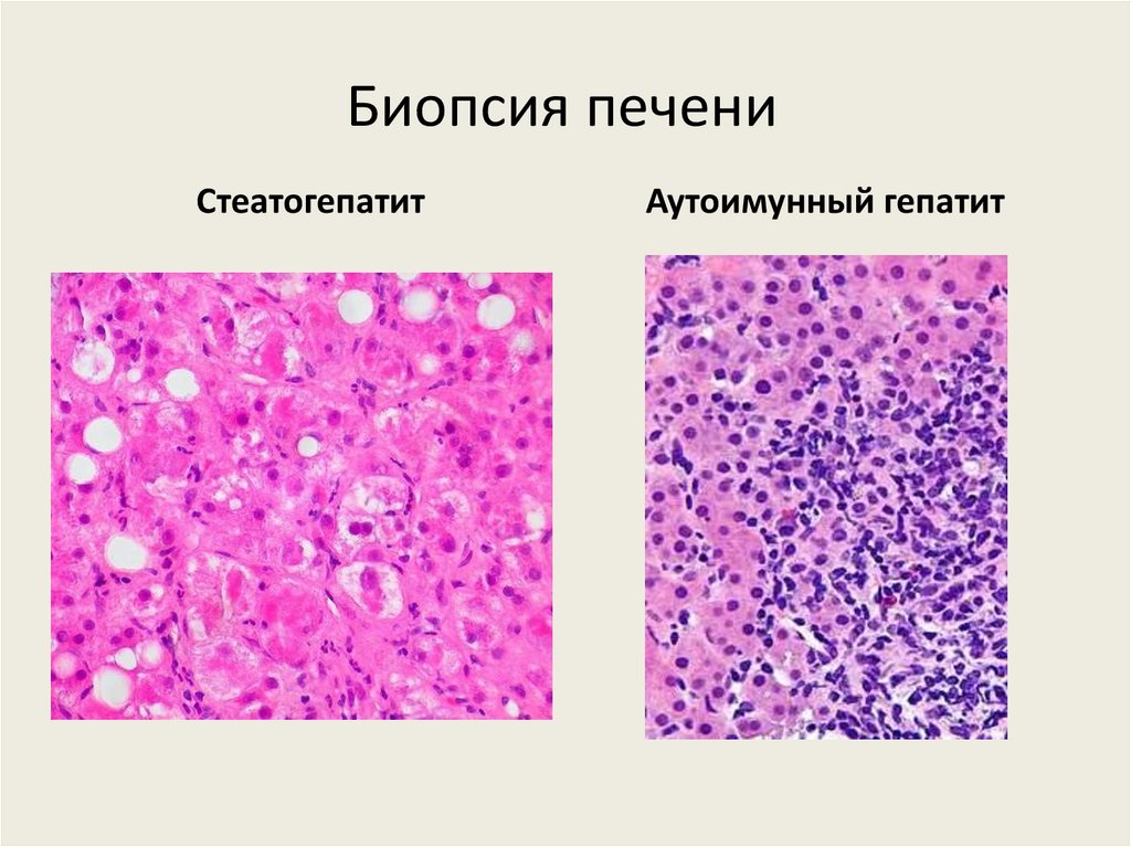 Биопсия печени