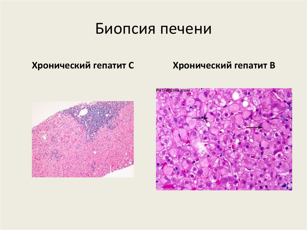 Биопсия печени