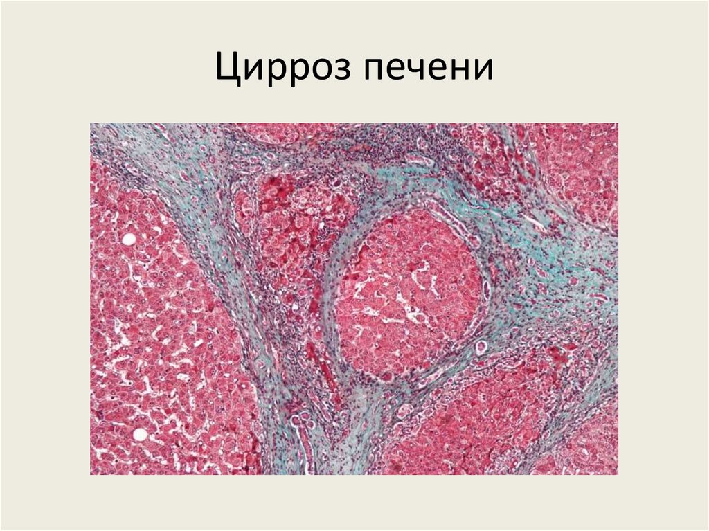 Цирроз печени