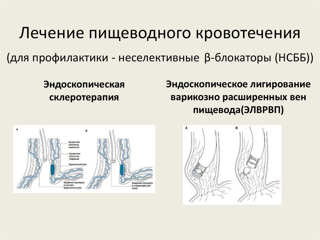 Лечение пищеводного кровотечения (для профилактики - неселективные β-блокаторы (НСББ))