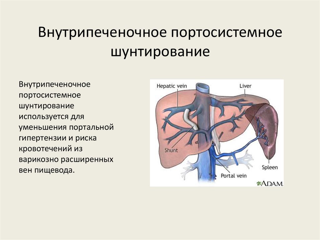 Внутрипеченочное портосистемное шунтирование