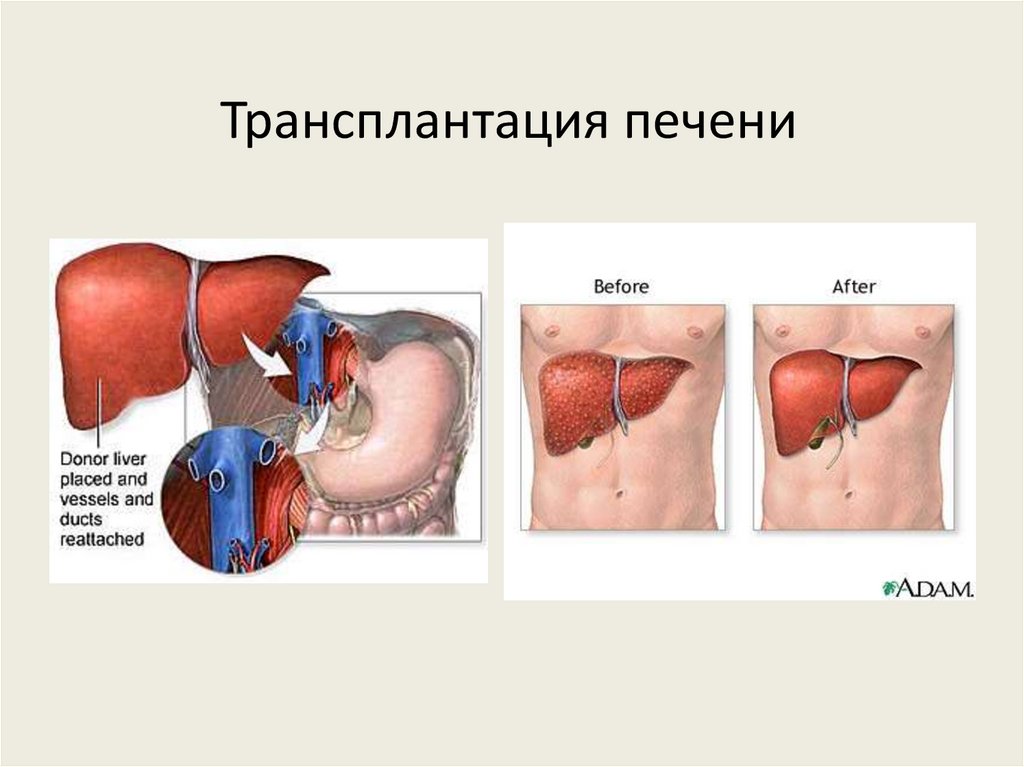 Трансплантация печени