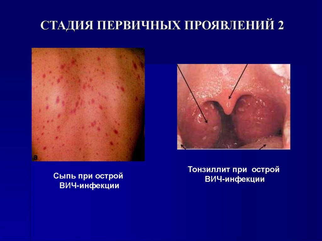 СТАДИЯ ПЕРВИЧНЫХ ПРОЯВЛЕНИЙ 2