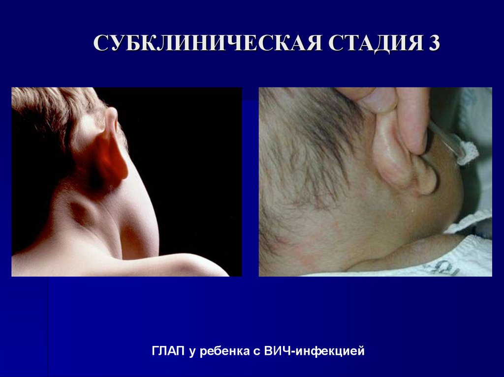 СУБКЛИНИЧЕСКАЯ СТАДИЯ 3