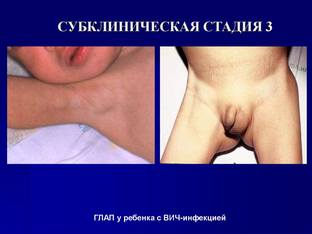 СУБКЛИНИЧЕСКАЯ СТАДИЯ 3
