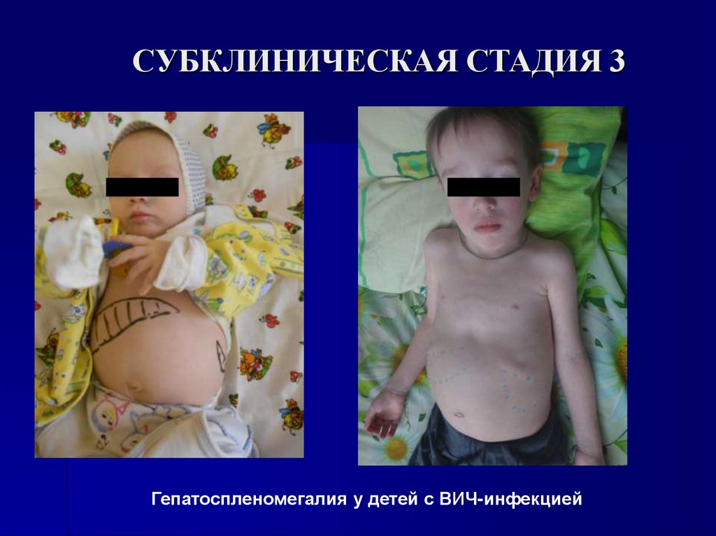 СУБКЛИНИЧЕСКАЯ СТАДИЯ 3