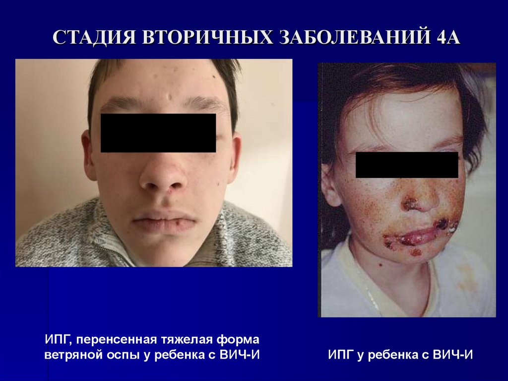 СТАДИЯ ВТОРИЧНЫХ ЗАБОЛЕВАНИЙ 4А