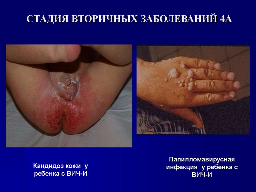 СТАДИЯ ВТОРИЧНЫХ ЗАБОЛЕВАНИЙ 4А