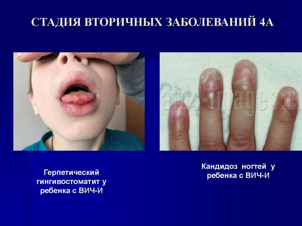 СТАДИЯ ВТОРИЧНЫХ ЗАБОЛЕВАНИЙ 4А