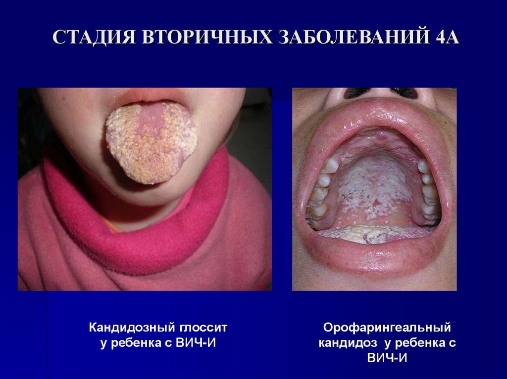 СТАДИЯ ВТОРИЧНЫХ ЗАБОЛЕВАНИЙ 4А