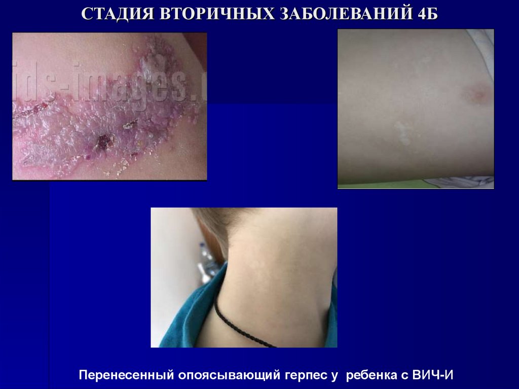 СТАДИЯ ВТОРИЧНЫХ ЗАБОЛЕВАНИЙ 4Б