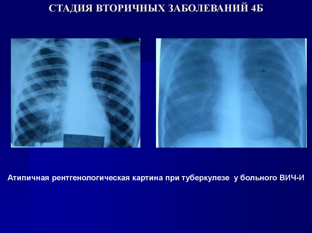 СТАДИЯ ВТОРИЧНЫХ ЗАБОЛЕВАНИЙ 4Б