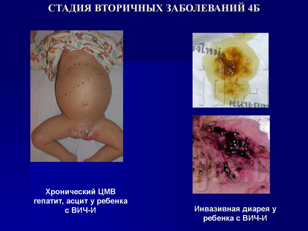 СТАДИЯ ВТОРИЧНЫХ ЗАБОЛЕВАНИЙ 4Б