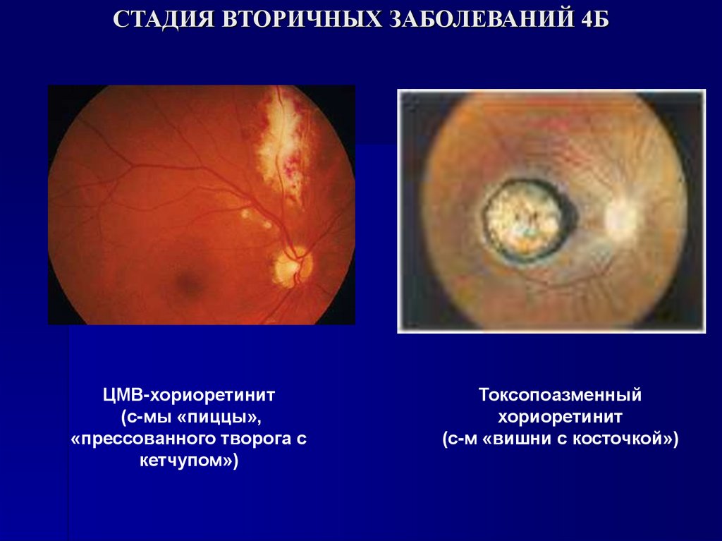 СТАДИЯ ВТОРИЧНЫХ ЗАБОЛЕВАНИЙ 4Б