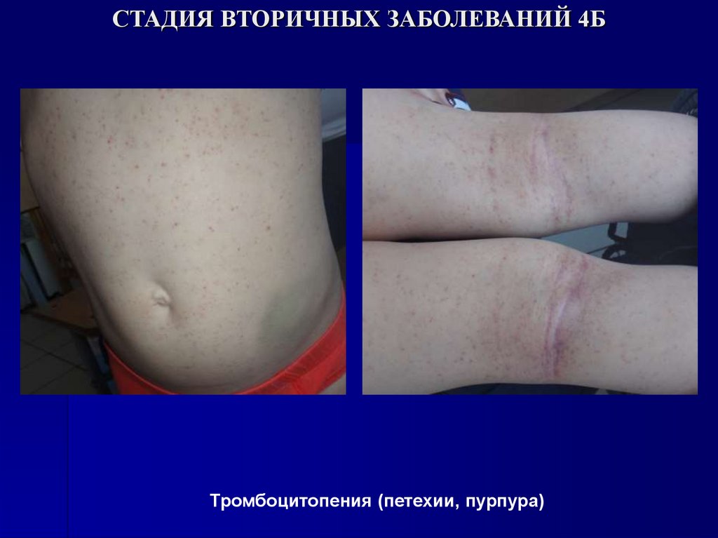 СТАДИЯ ВТОРИЧНЫХ ЗАБОЛЕВАНИЙ 4Б