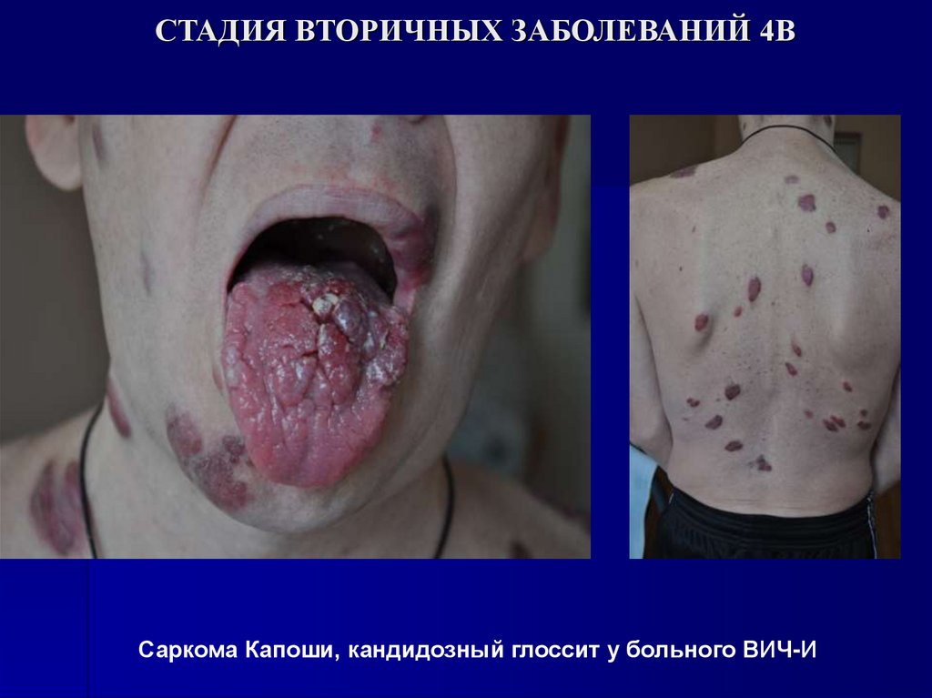 СТАДИЯ ВТОРИЧНЫХ ЗАБОЛЕВАНИЙ 4В