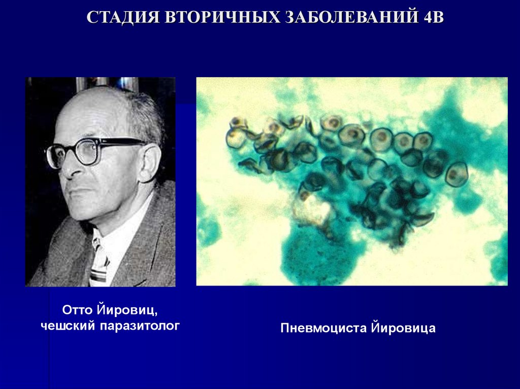 СТАДИЯ ВТОРИЧНЫХ ЗАБОЛЕВАНИЙ 4В