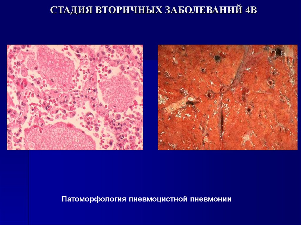 СТАДИЯ ВТОРИЧНЫХ ЗАБОЛЕВАНИЙ 4В