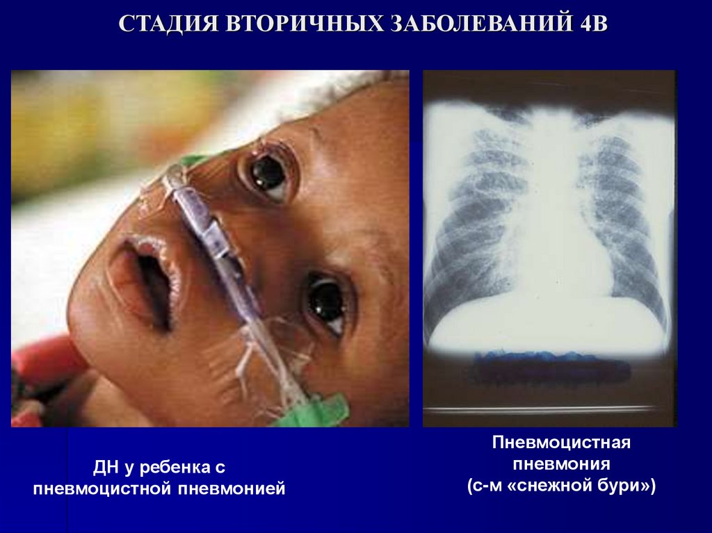 СТАДИЯ ВТОРИЧНЫХ ЗАБОЛЕВАНИЙ 4В