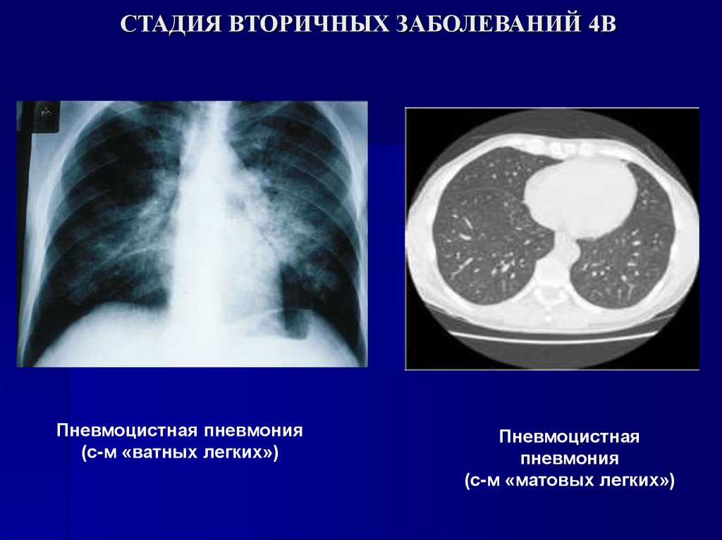 СТАДИЯ ВТОРИЧНЫХ ЗАБОЛЕВАНИЙ 4В