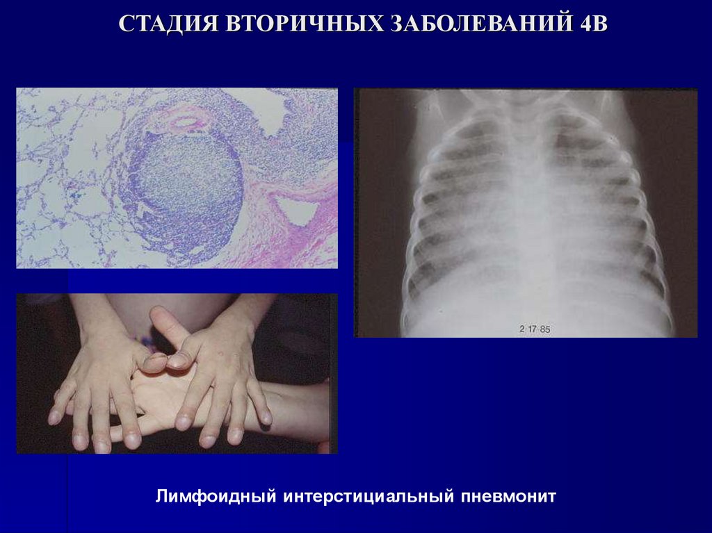 СТАДИЯ ВТОРИЧНЫХ ЗАБОЛЕВАНИЙ 4В