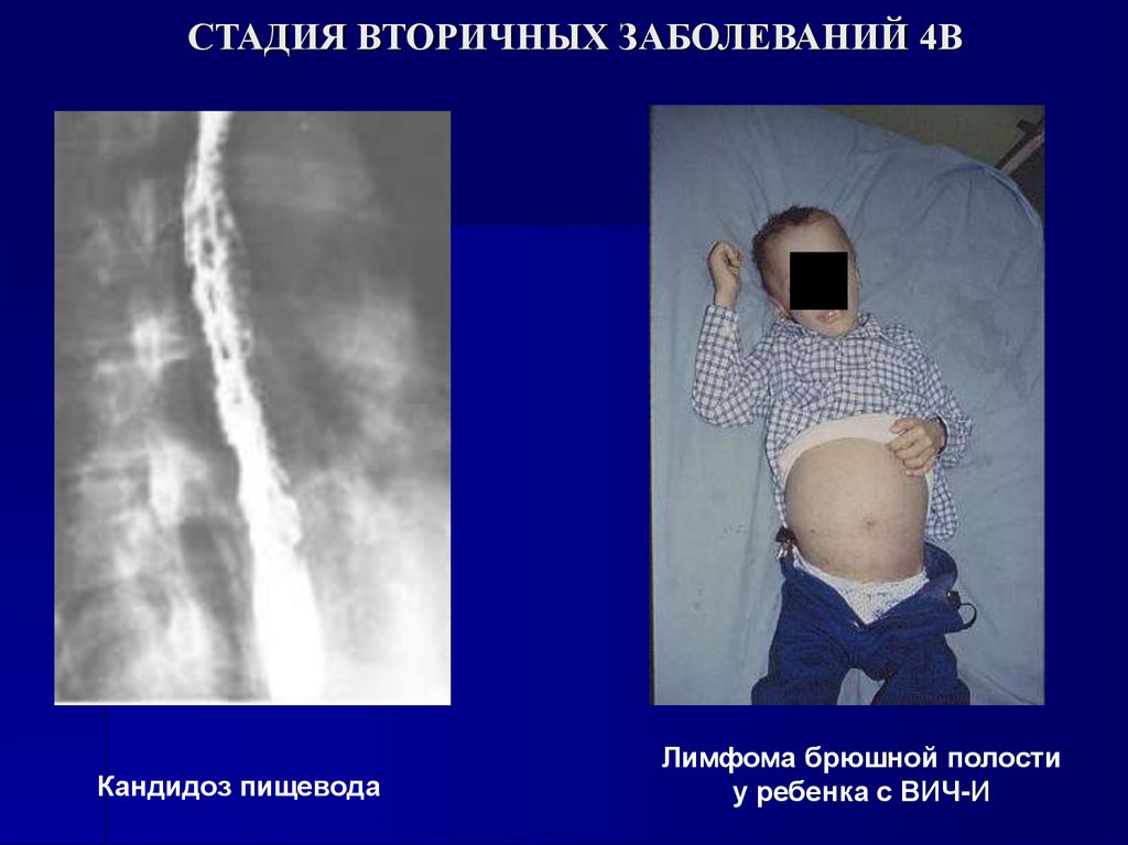 СТАДИЯ ВТОРИЧНЫХ ЗАБОЛЕВАНИЙ 4В