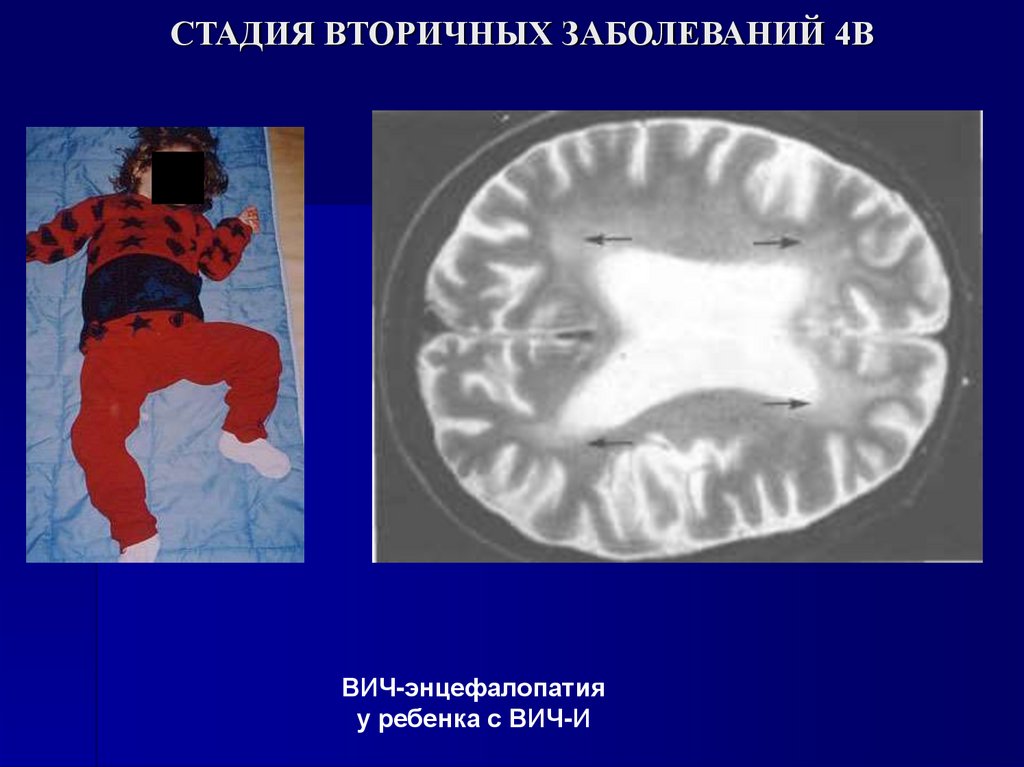 СТАДИЯ ВТОРИЧНЫХ ЗАБОЛЕВАНИЙ 4В