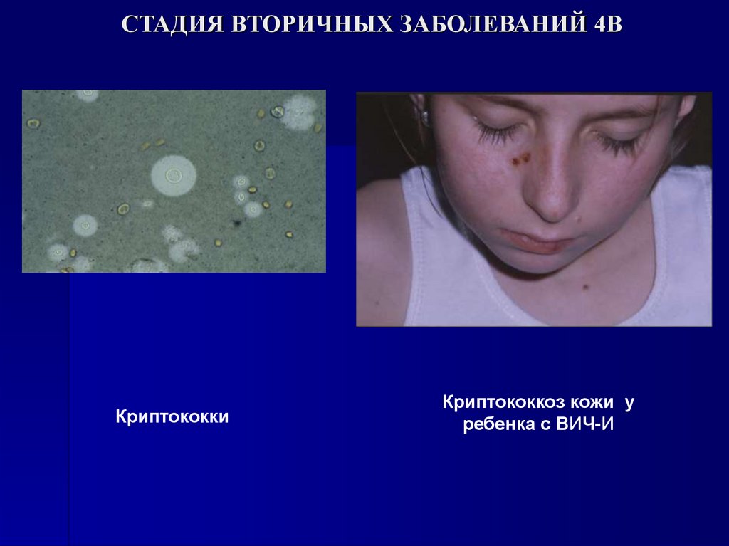 СТАДИЯ ВТОРИЧНЫХ ЗАБОЛЕВАНИЙ 4В