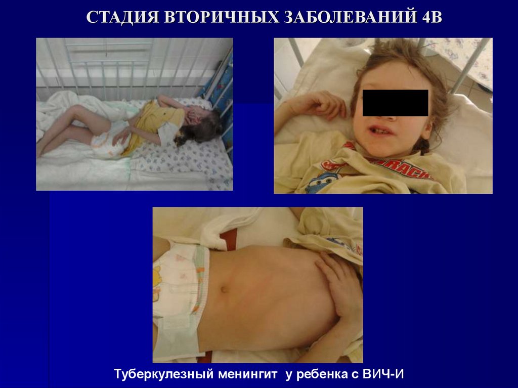 СТАДИЯ ВТОРИЧНЫХ ЗАБОЛЕВАНИЙ 4В