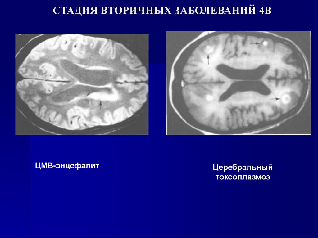 СТАДИЯ ВТОРИЧНЫХ ЗАБОЛЕВАНИЙ 4В
