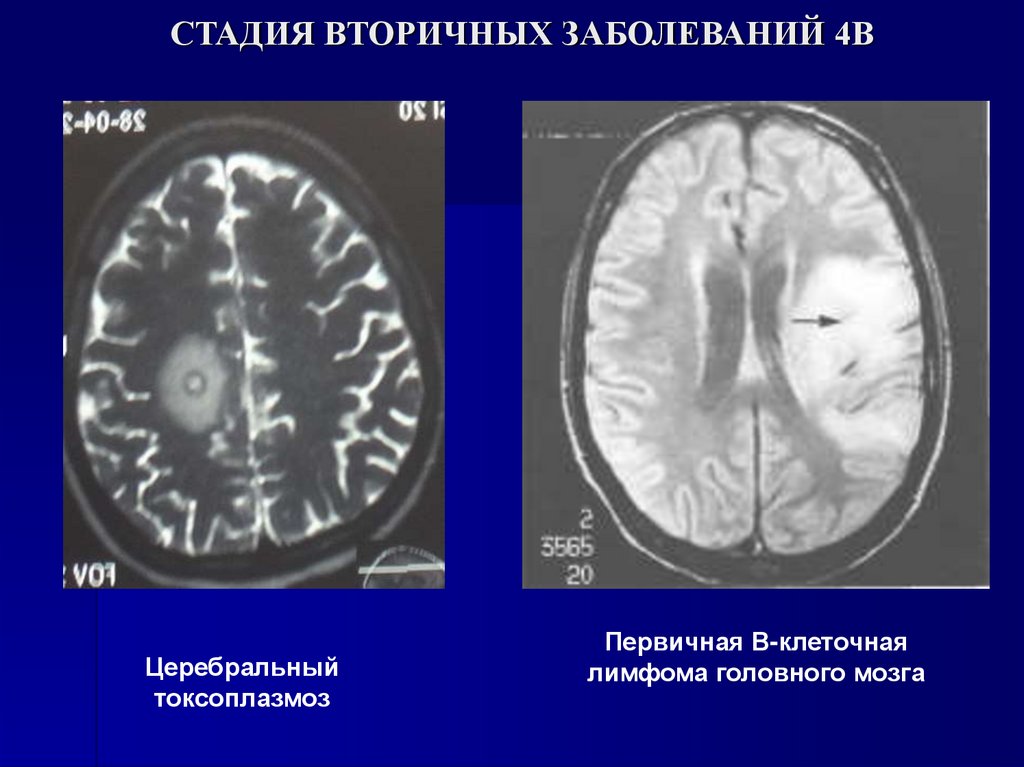 СТАДИЯ ВТОРИЧНЫХ ЗАБОЛЕВАНИЙ 4В