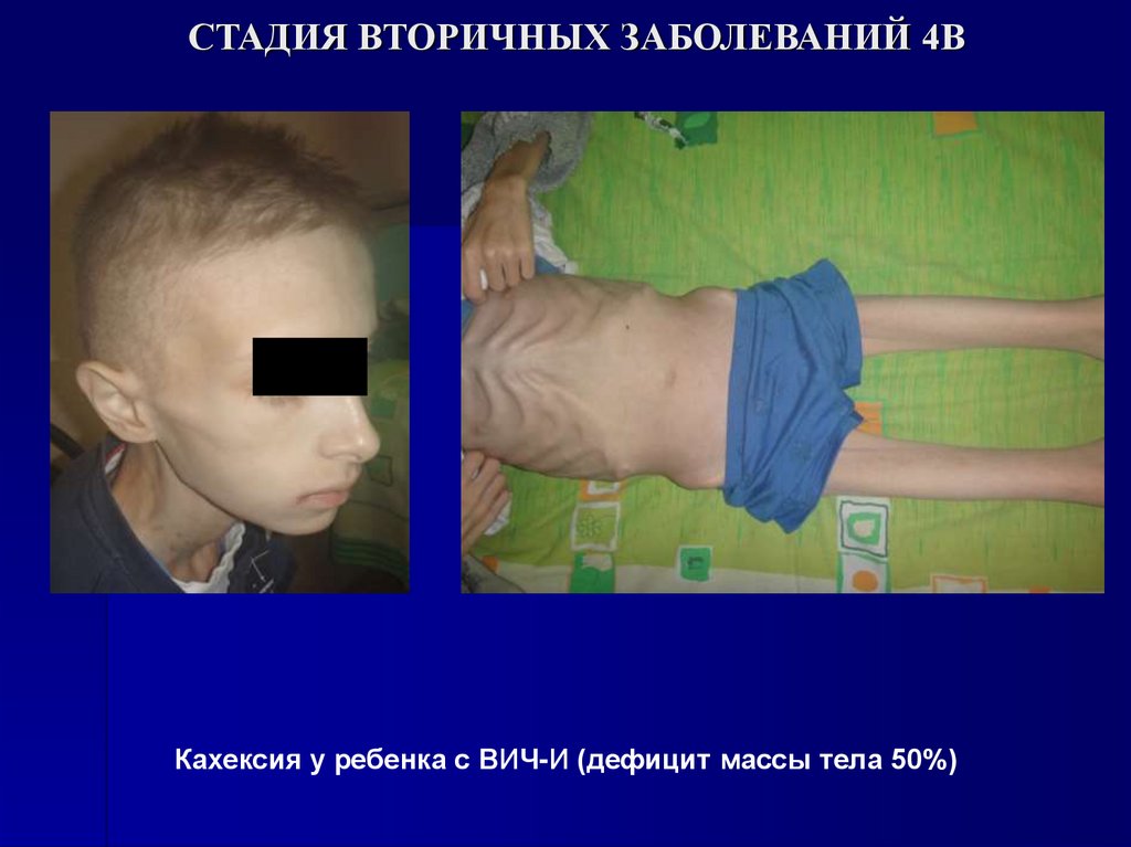 СТАДИЯ ВТОРИЧНЫХ ЗАБОЛЕВАНИЙ 4В