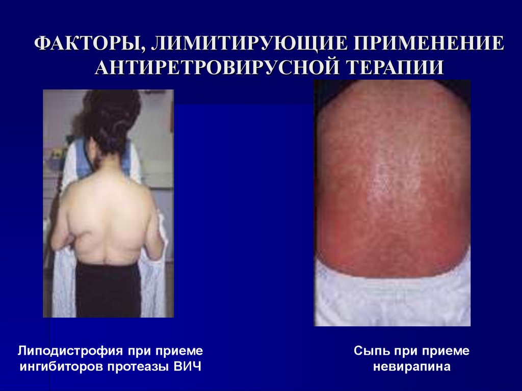 ФАКТОРЫ, ЛИМИТИРУЮЩИЕ ПРИМЕНЕНИЕ АНТИРЕТРОВИРУСНОЙ ТЕРАПИИ