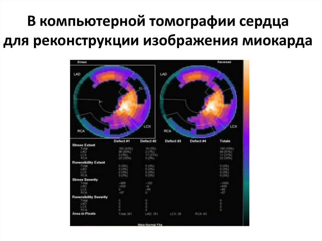 В компьютерной томографии сердца для реконструкции изображения миокарда