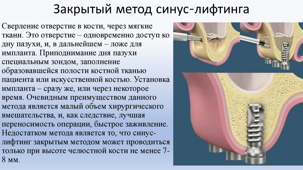 Закрытый метод синус-лифтинга