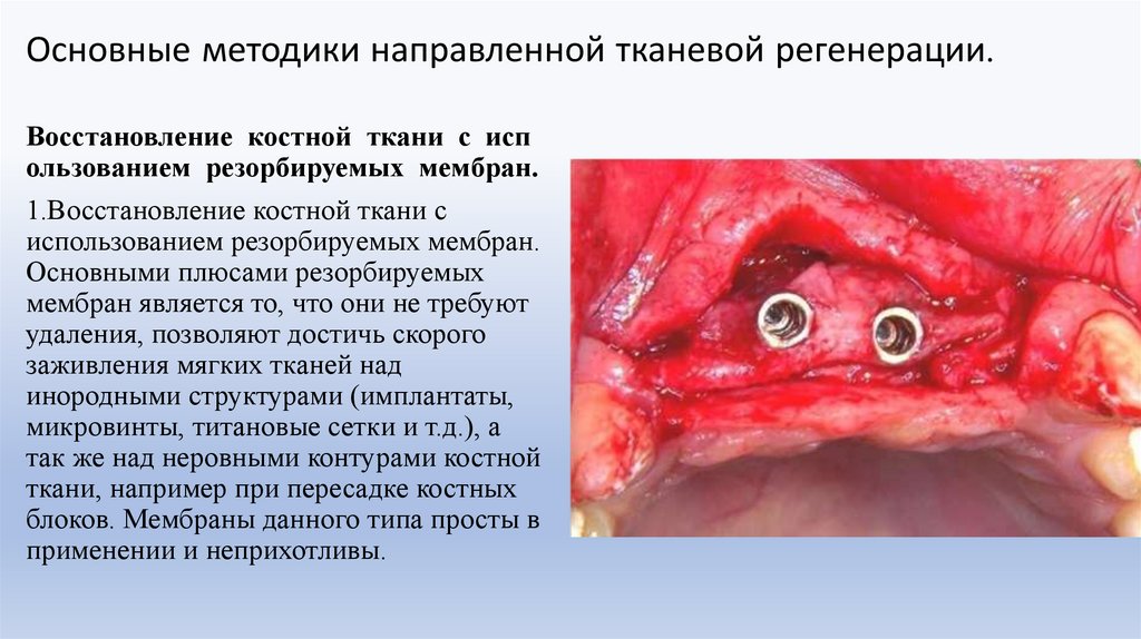Основные методики направленной тканевой регенерации.