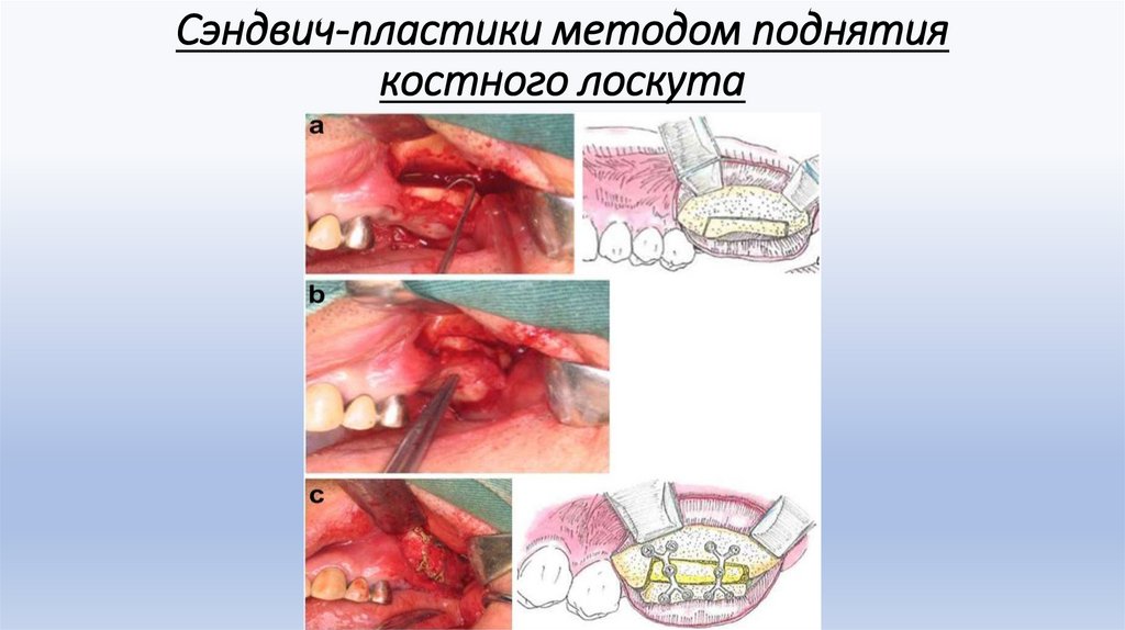 Сэндвич-пластики методом поднятия костного лоскута