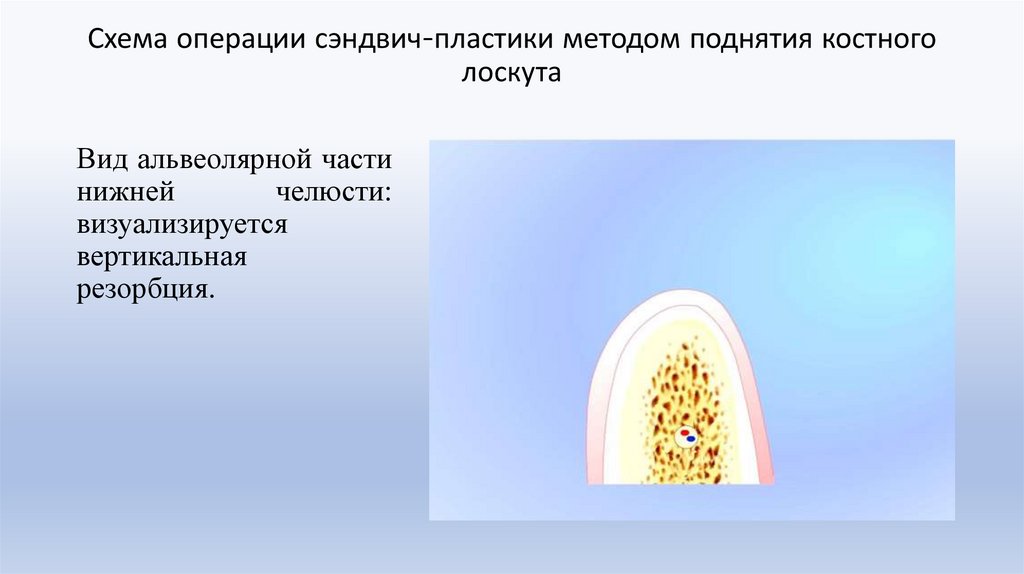 Схема операции сэндвич-пластики методом поднятия костного лоскута
